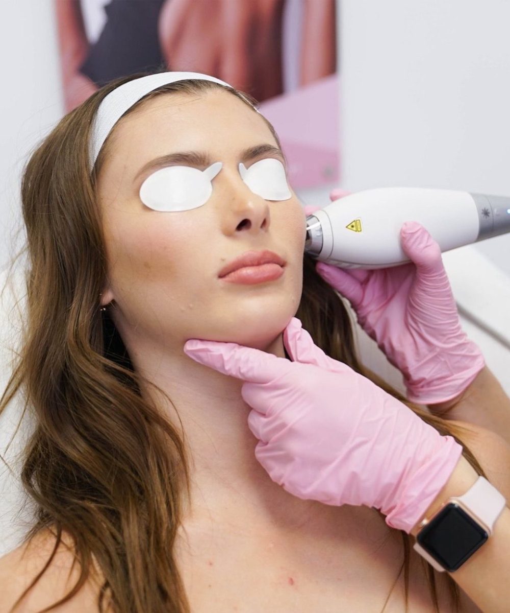 LaserAway skin care procedure